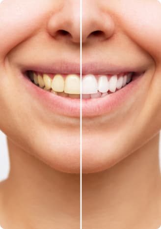 Teeth Whitening